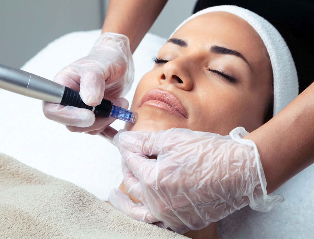 Tratamiento facial de Dermapen el salón de Lorena Vicedo