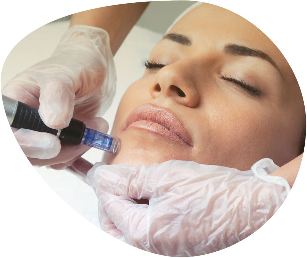 Servicios de tratamientos faciales. Dermapen